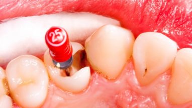 Kanal Tedavisi Yapılan Dişin Ağrıması Nedenleri