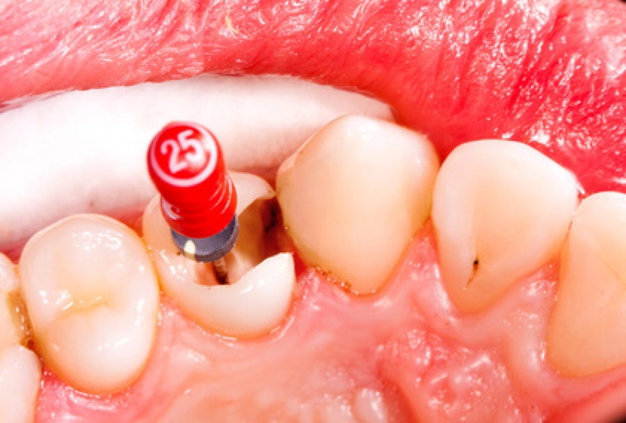 kanal tedavisi yapılan dişin ağrıması