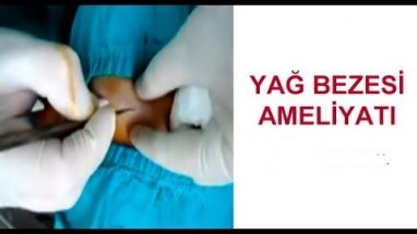 Yağ Bezesi Ameliyatı İyileşme Süreci