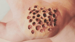 Tripofobi nedir? Tripofobi neden olur?