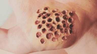 Tripofobi nedir? Tripofobi neden olur?