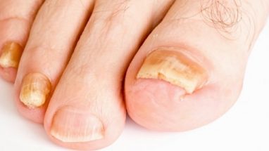 Ayak Tırnakları Neden Sararır